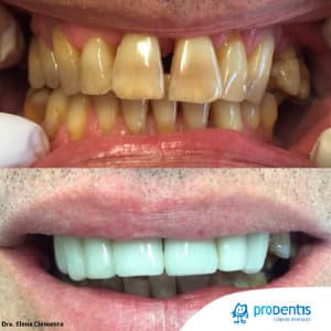 Microcarillas dentales: precio, sin tallado y duración