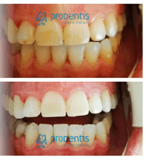 Blanqueamiento dental