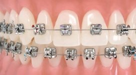 ortodoncia tradicional