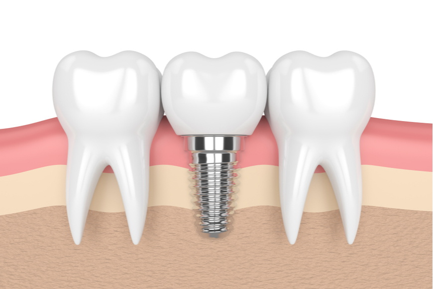 Implantes dentales titanio