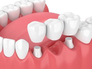implante dental clinica