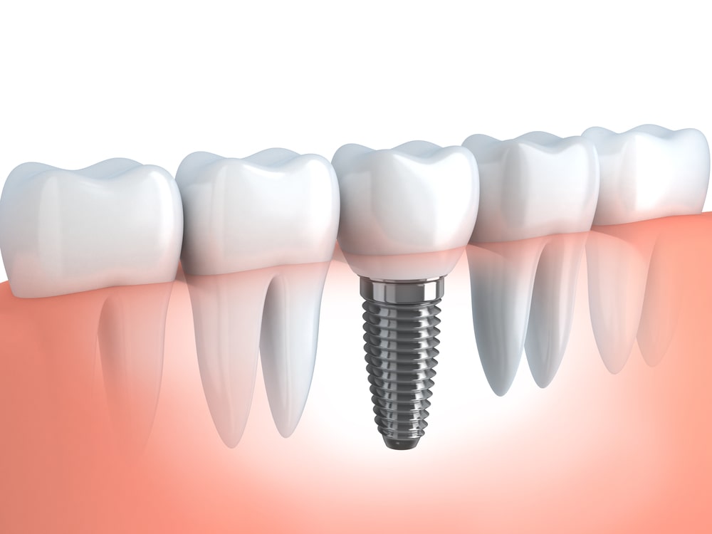puente dental o implante dental