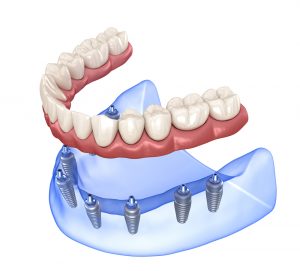 precio implantes dentales