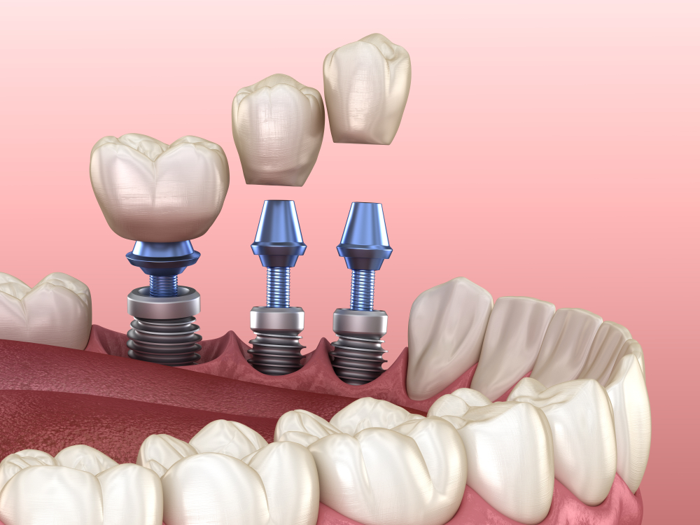 implante dental partes