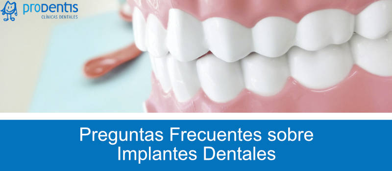 pregutnas frecuentes implantes dentales