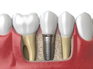 implante dental clinica prodentis